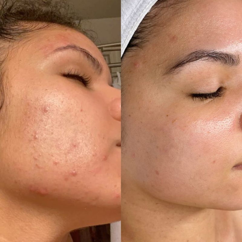 Revela Skin Pads